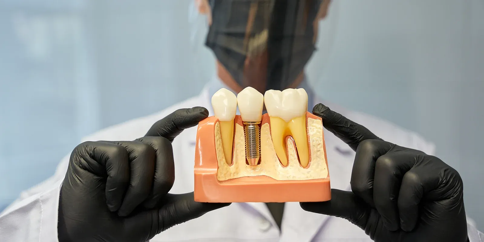 Best dental implants in Napa