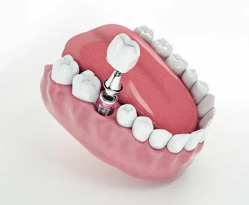 Best dental implants in Napa