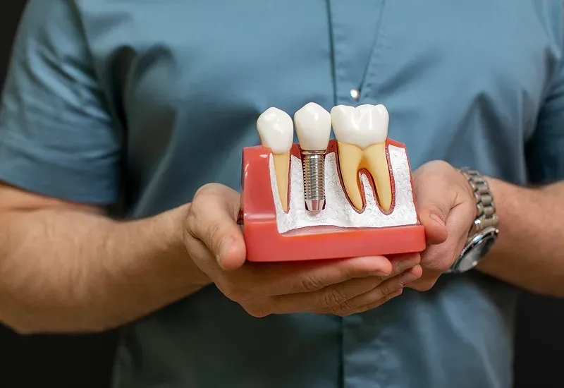 Best dental implants in Napa