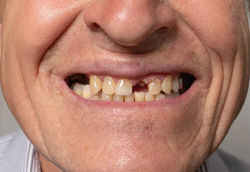 Can You Get Veneers with Crooked or Missing Teeth?