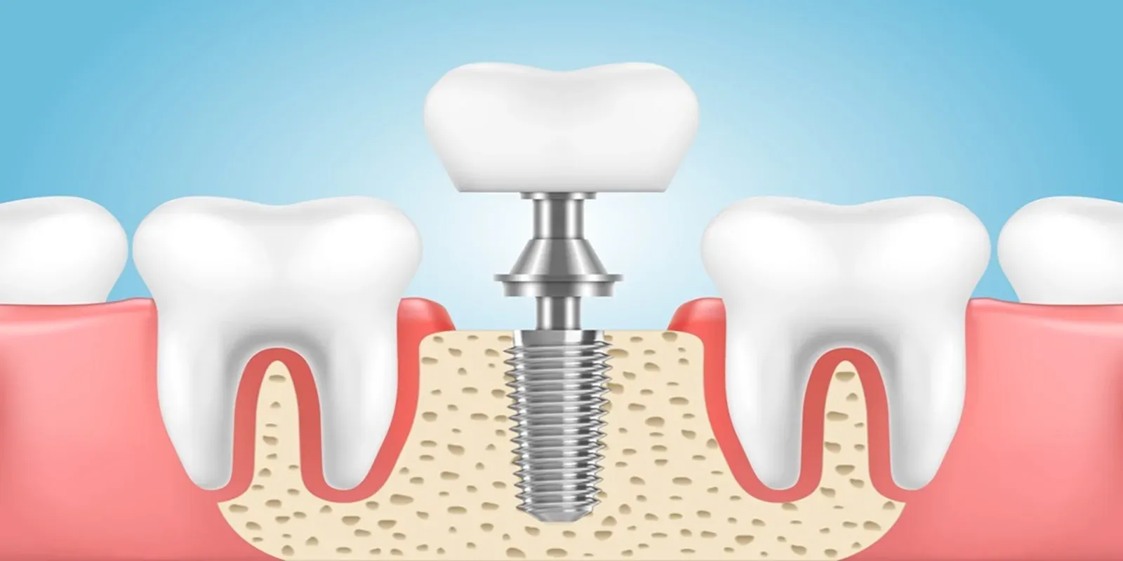 Dental Implant Process: Step-by-Step Guide 