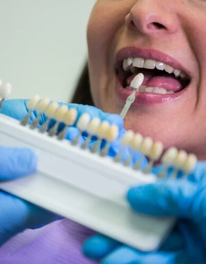 How Long Do Veneers Last? Durability and Replacement Guide