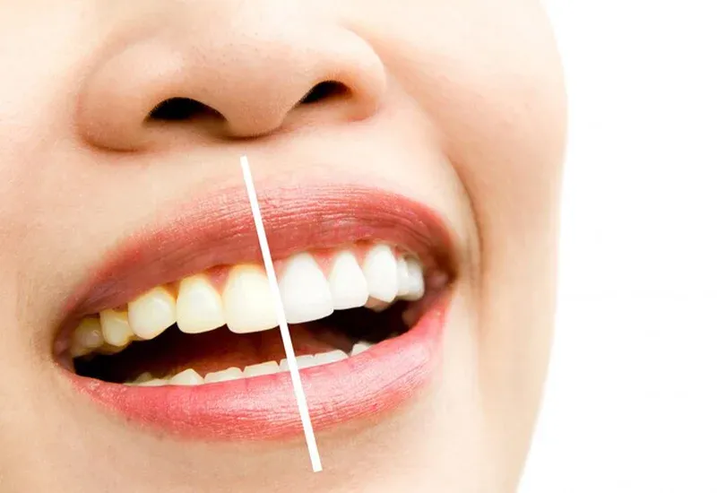 How Long Do Veneers Last? Durability and Replacement Guide